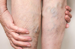 Varicoza pe picioare puternice tratament - Varice - cauze, simptome si tratament